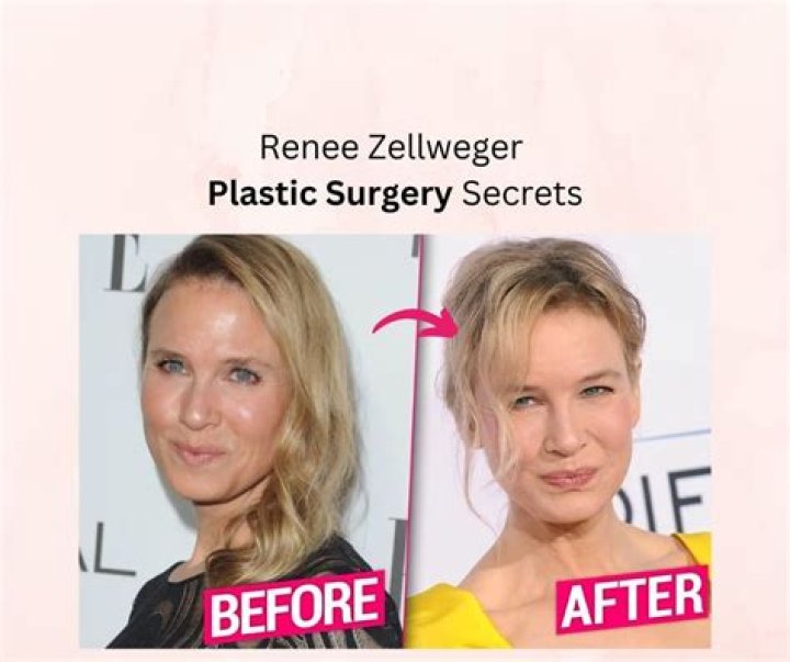 A Dive into Renee Zellweger’s Plastic Surgery Rumors and Her Response to Them over the Years